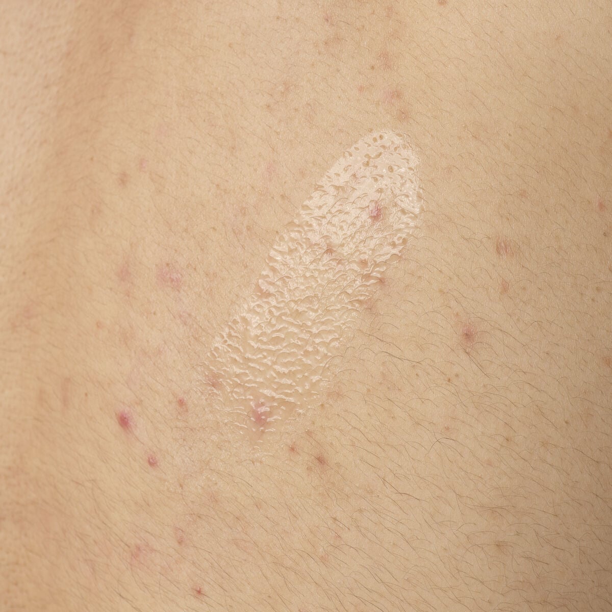 salicylic-acid-0-5-body-serum-x9 ORD-salicylic-acid-05-body-240ml-application.jpg
