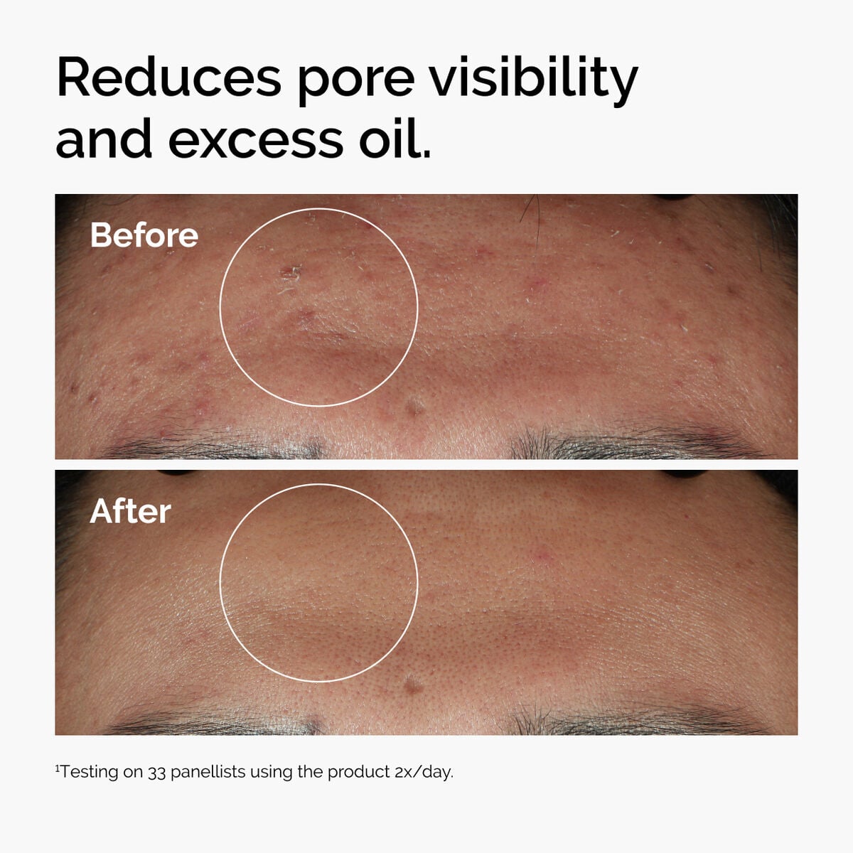 niacinamide-10-zinc-1-w3 ord-niacinamide-zinc-blemish-serum-before-after-pores.jpg