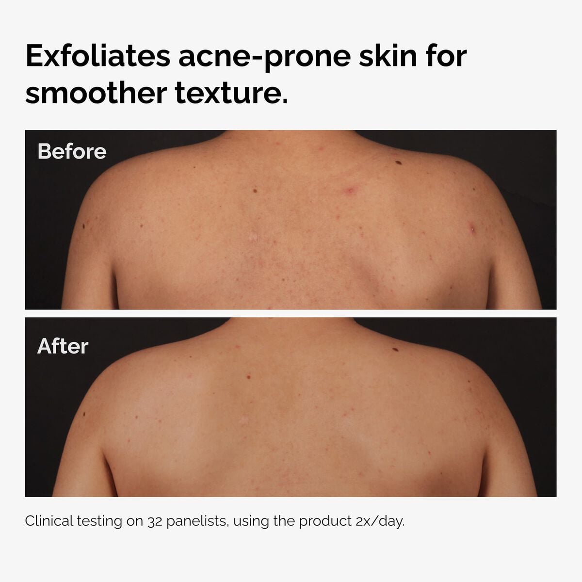salicylic-acid-0-5-body-serum-x9 ord-salicylic-acid-body-serum-before-after-graphic-NA.jpg