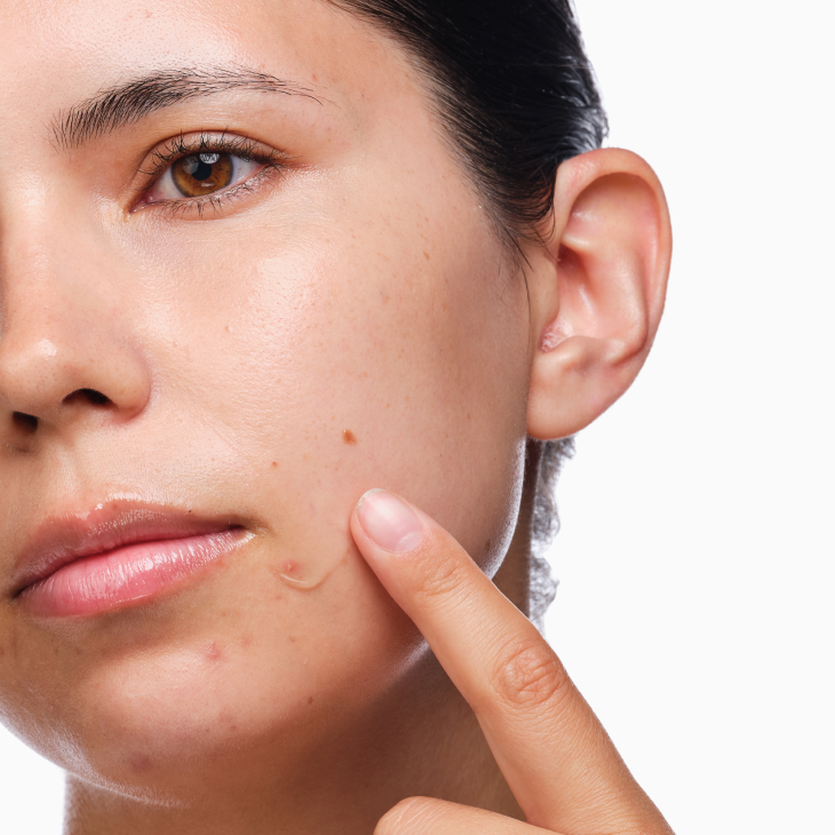 the-acne-set-h9 rdn-the-acne-set-application.png